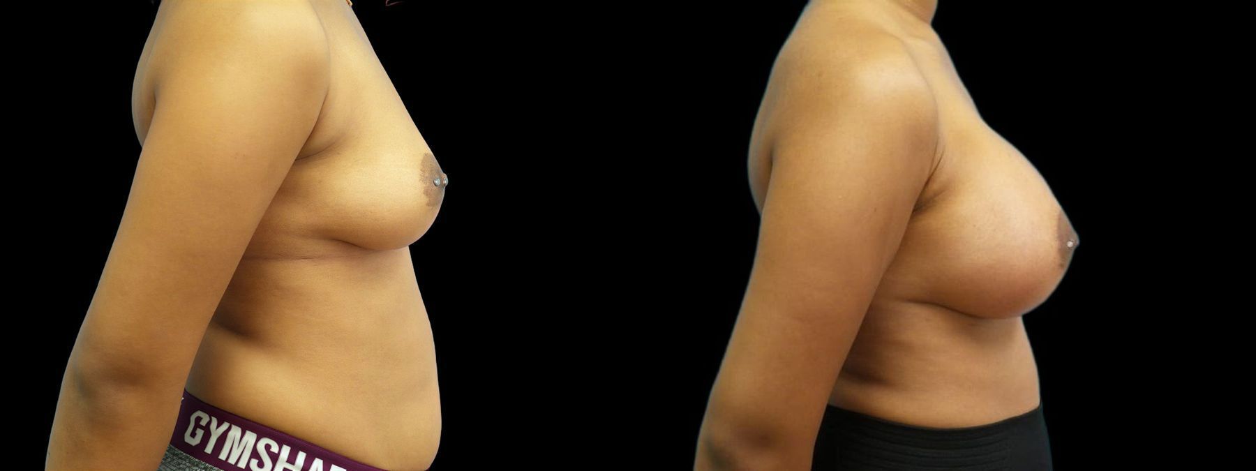 Before and after Breast Augmentation case 43021 - Angle 2