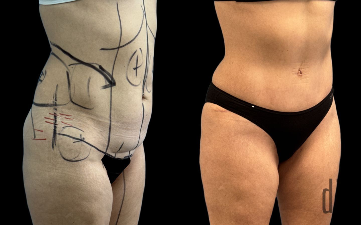 Before and after Liposuction case 33055 - Angle 2