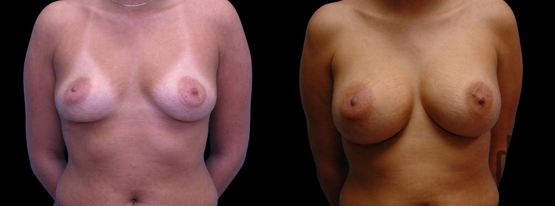 Before and after Breast Augmentation case 42602