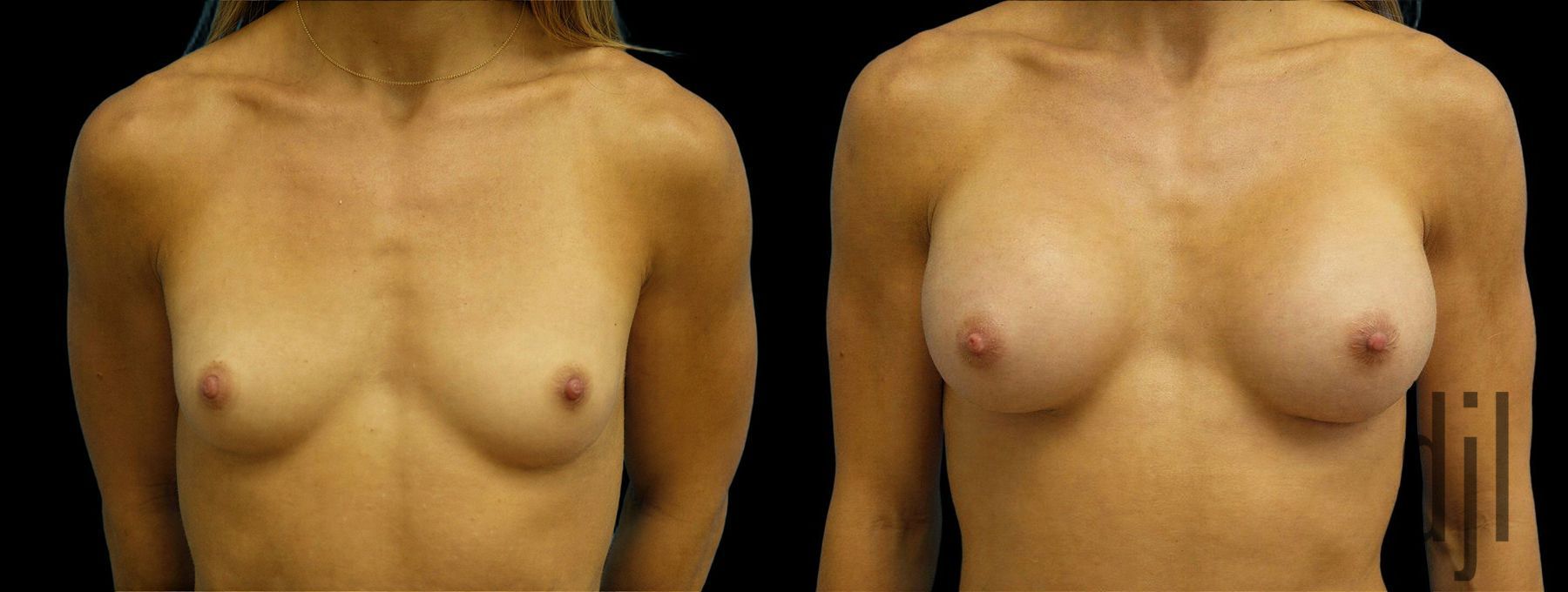 Before and after Breast Augmentation case 43002