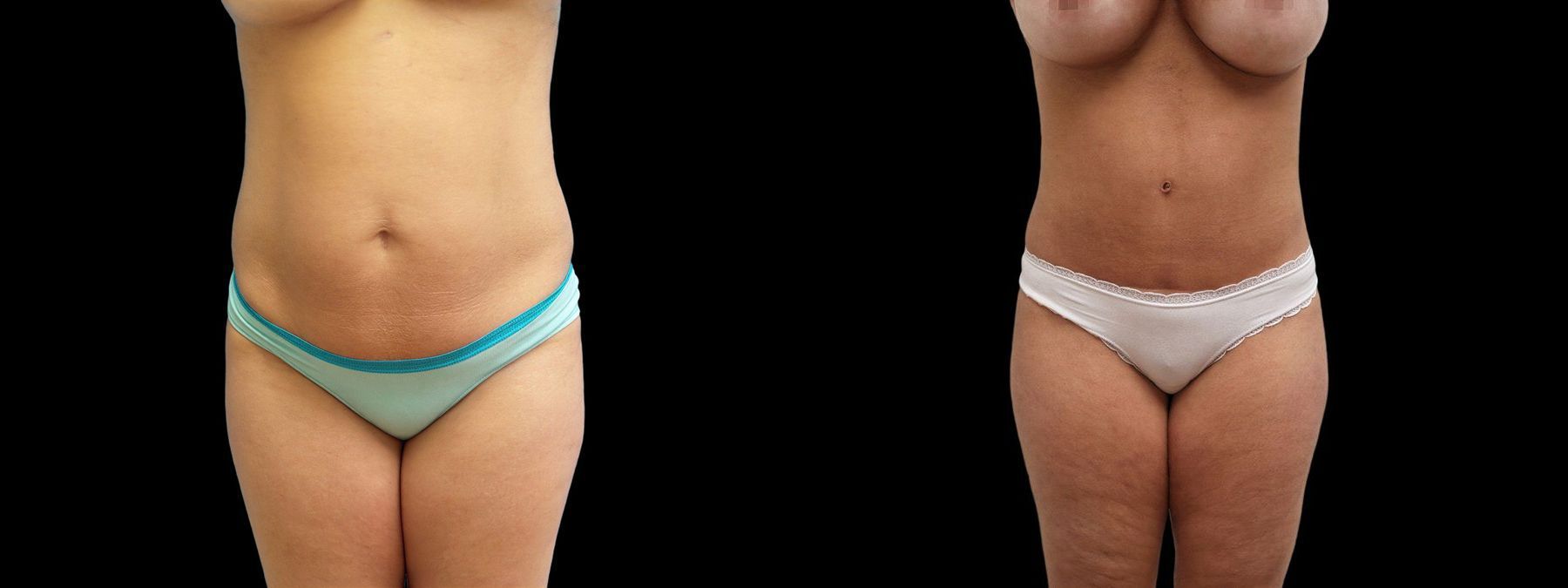 Before and after Tummy Tuck case 42934