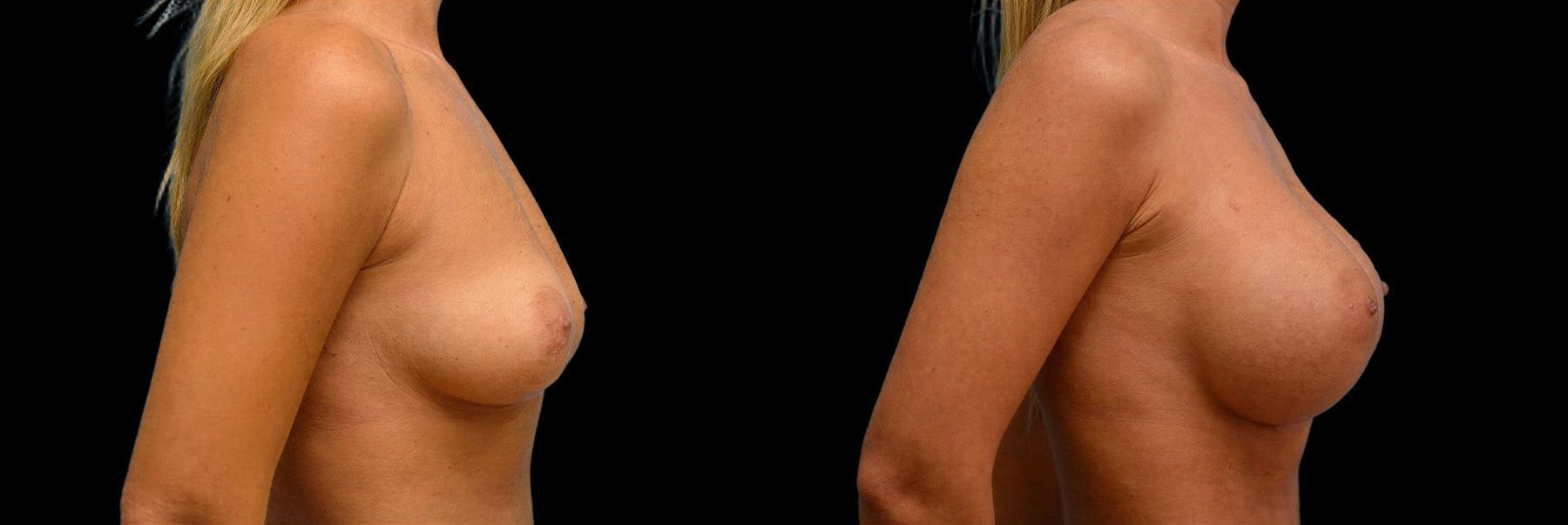 Before and after Breast Augmentation case 42883 - Angle 2