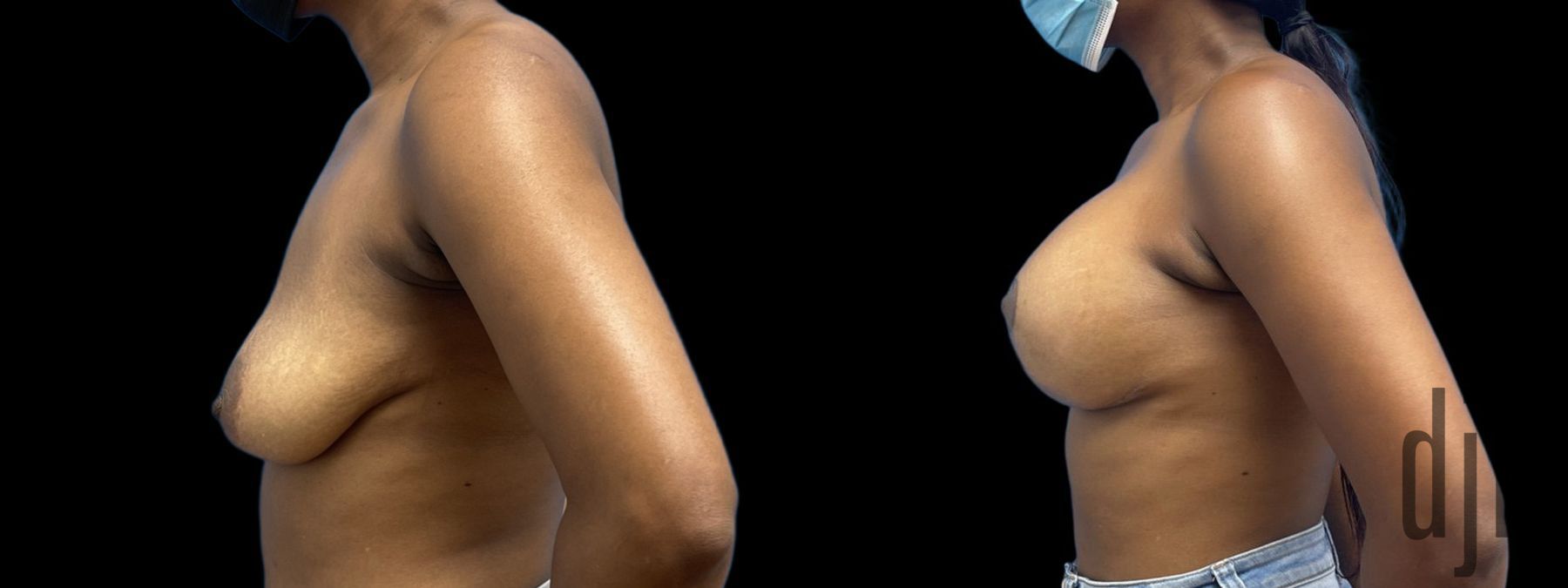 Before and after Breast Augmentation with Lift case 41231 - Angle 2