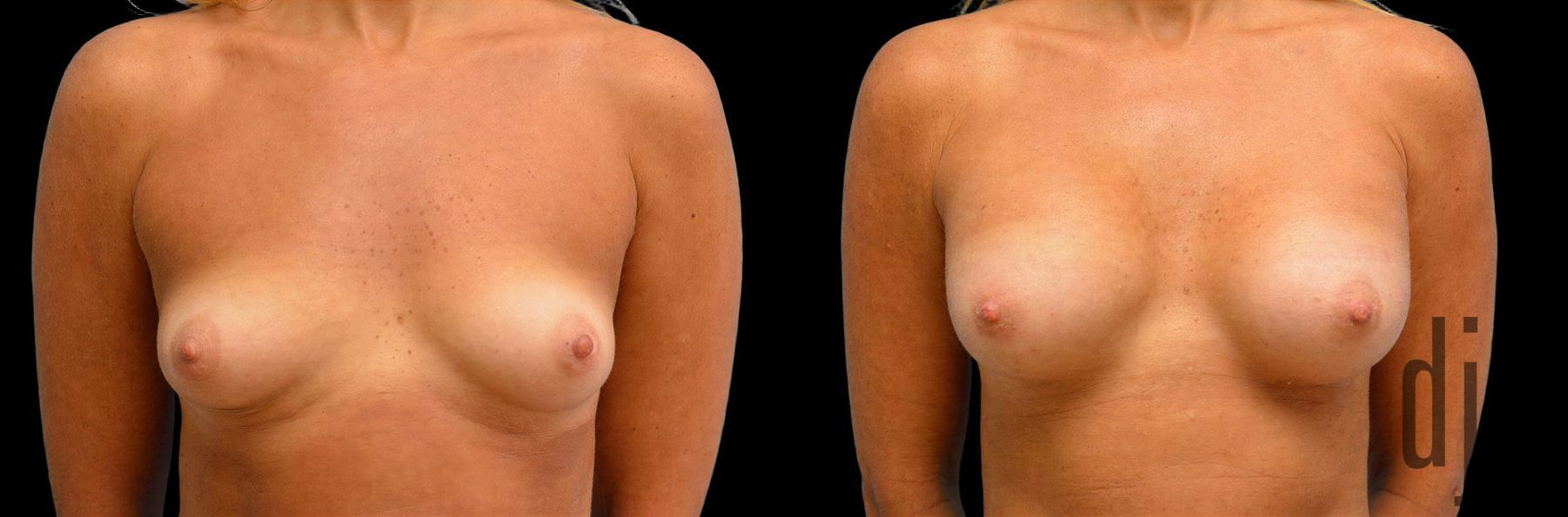 Before and after Breast Augmentation case 42921