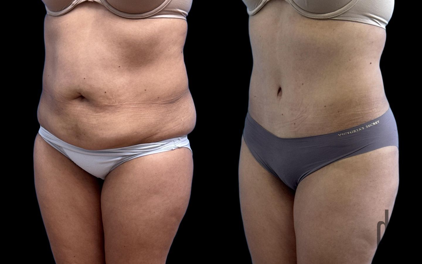 Before and after Tummy Tuck case 37378 - Angle 2
