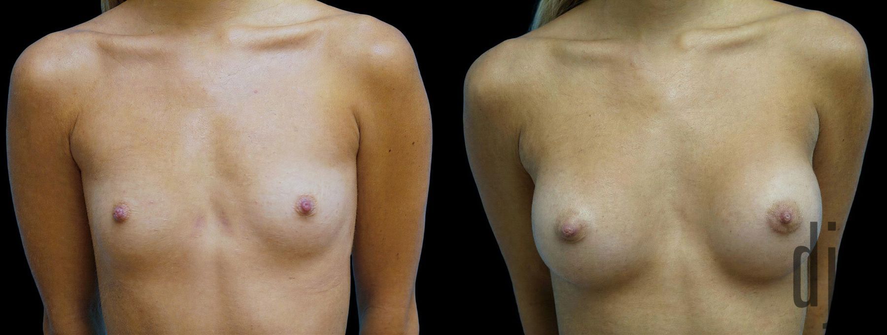 Before and after Breast Augmentation case 42940