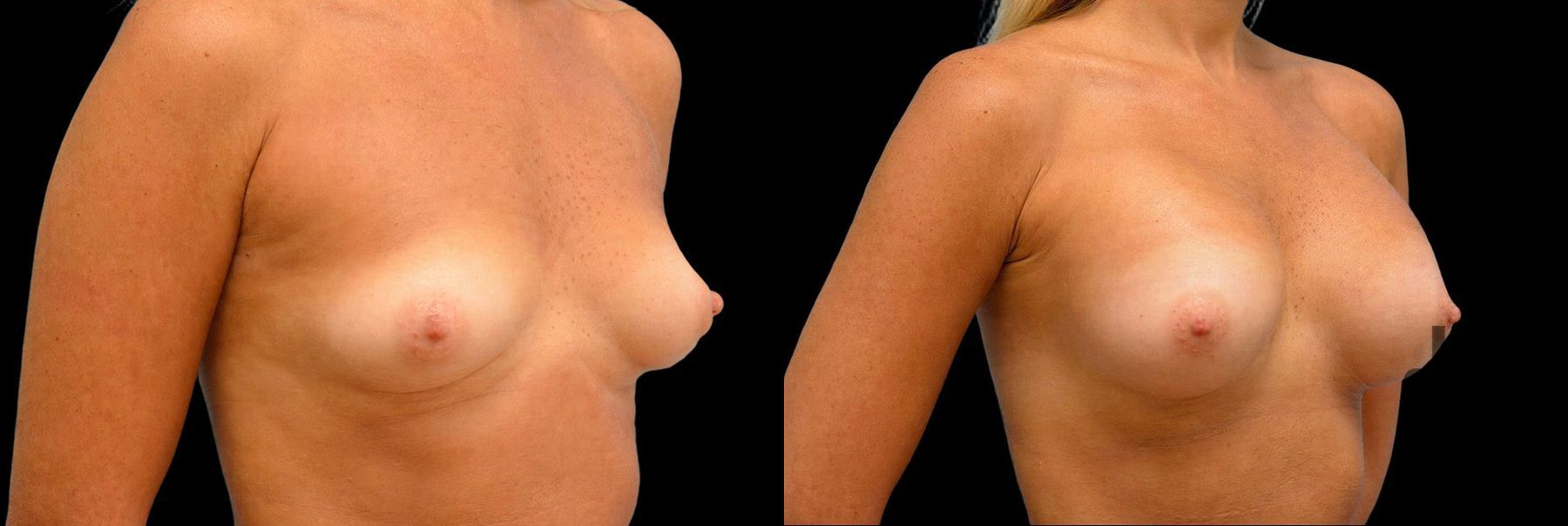 Before and after Breast Augmentation case 42921 - Angle 2