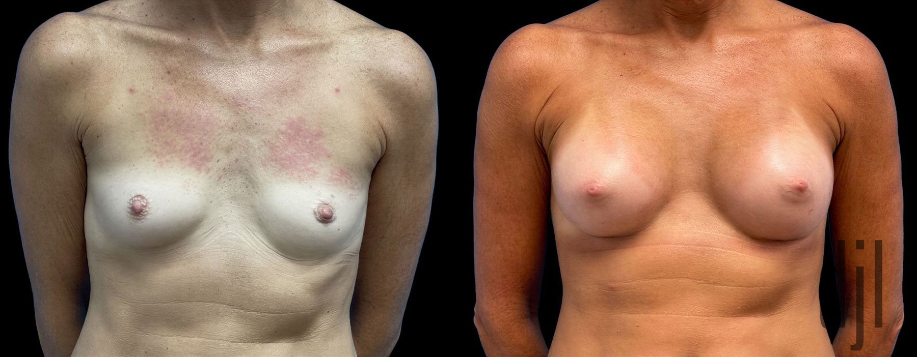 Before and after Breast Augmentation case 43035