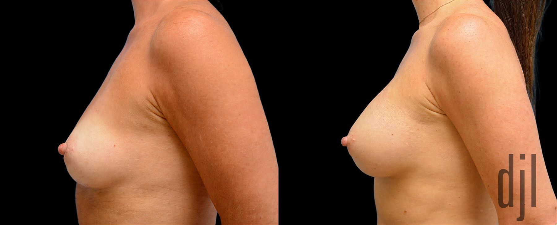 Before and after Breast Augmentation case 42849 - Angle 2