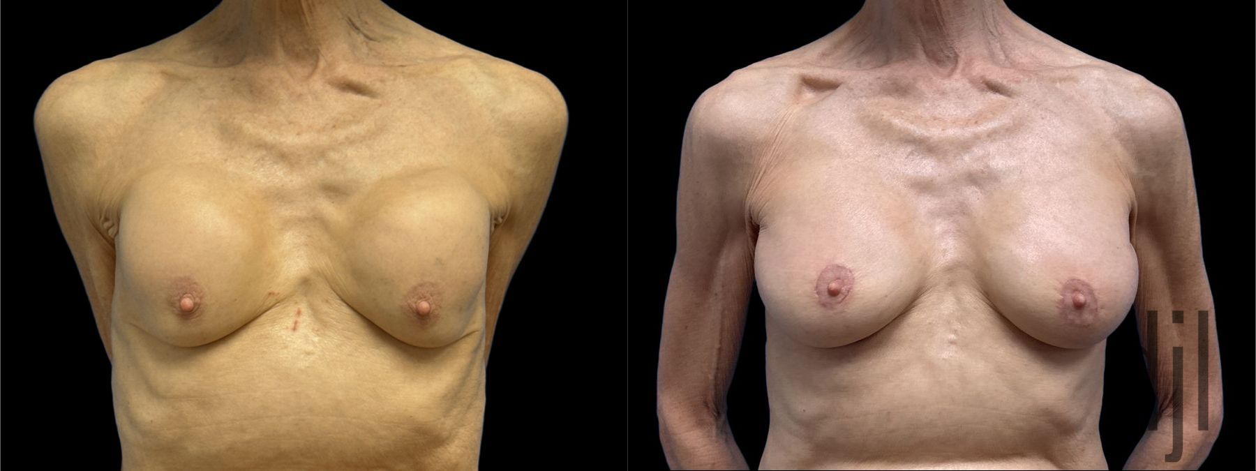 Before and after Breast Augmentation case 37376