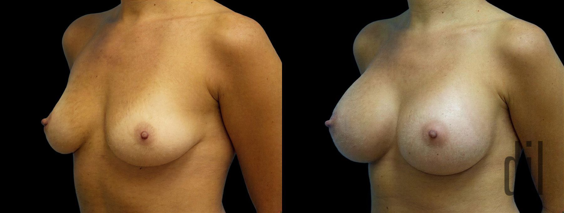 Before and after Breast Augmentation case 42943 - Angle 2