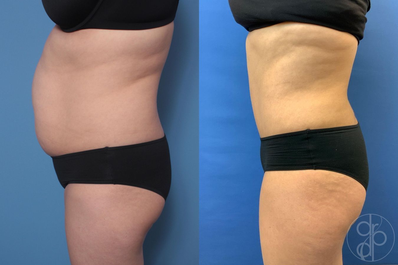 Before and after Liposuction case 29521 - Angle 2