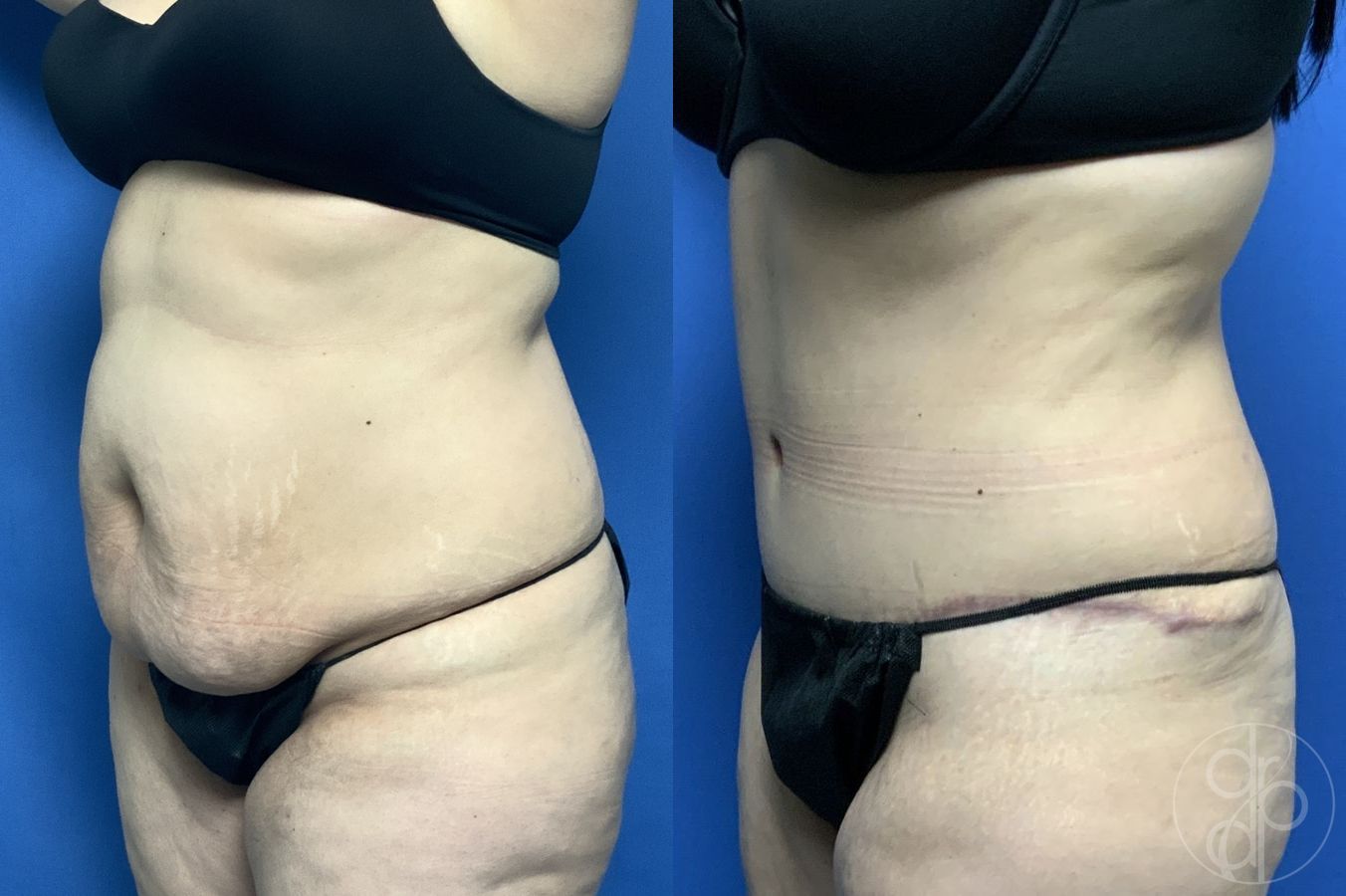 Before and after Abdominoplasty case 29575 - Angle 3