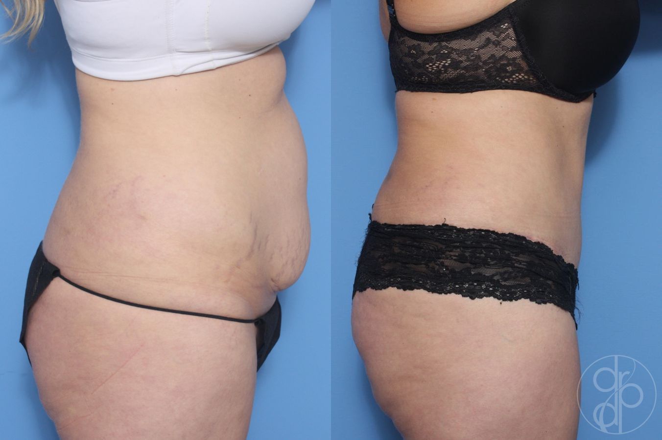 Before and after Abdominoplasty case 29536 - Angle 2