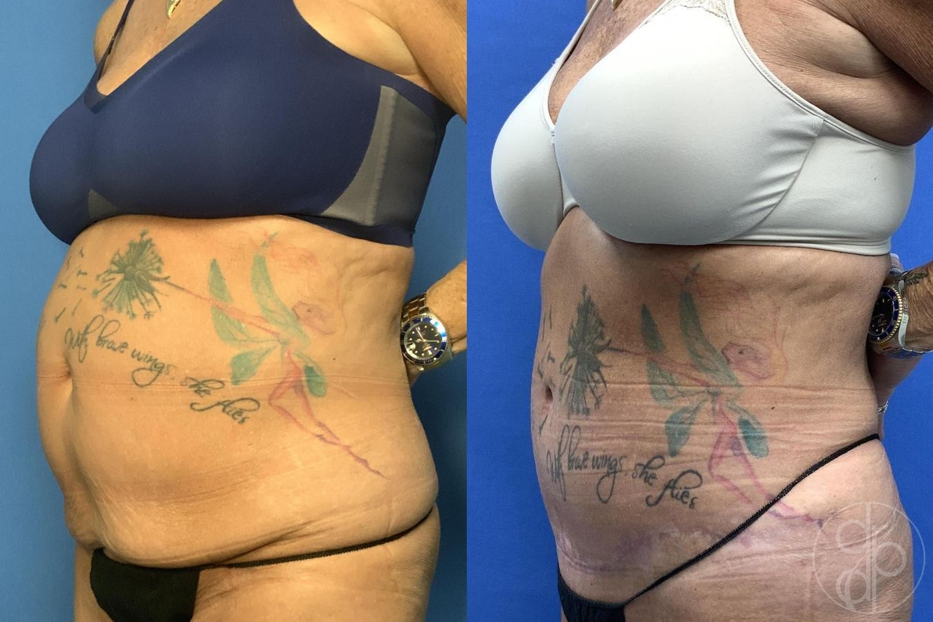 Before and after Abdominoplasty case 30022 - Angle 5