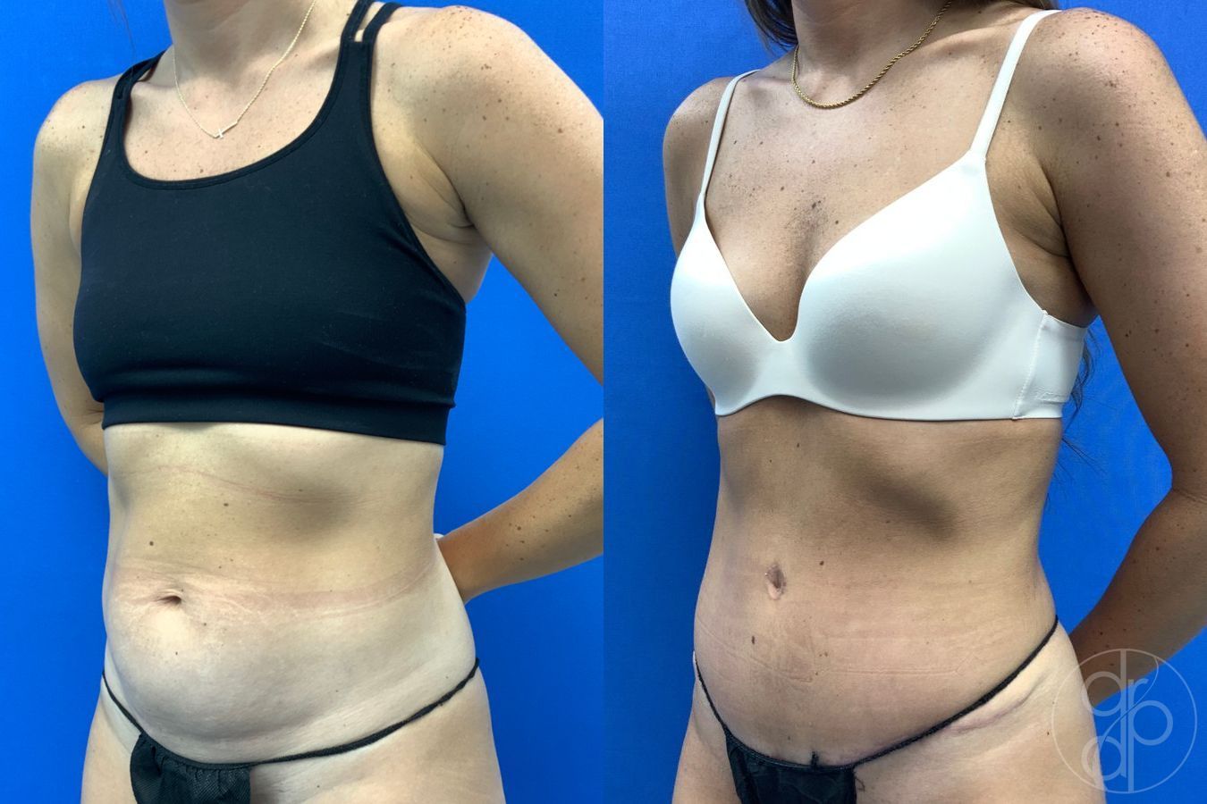 Before and after Abdominoplasty case 43175 - Angle 5