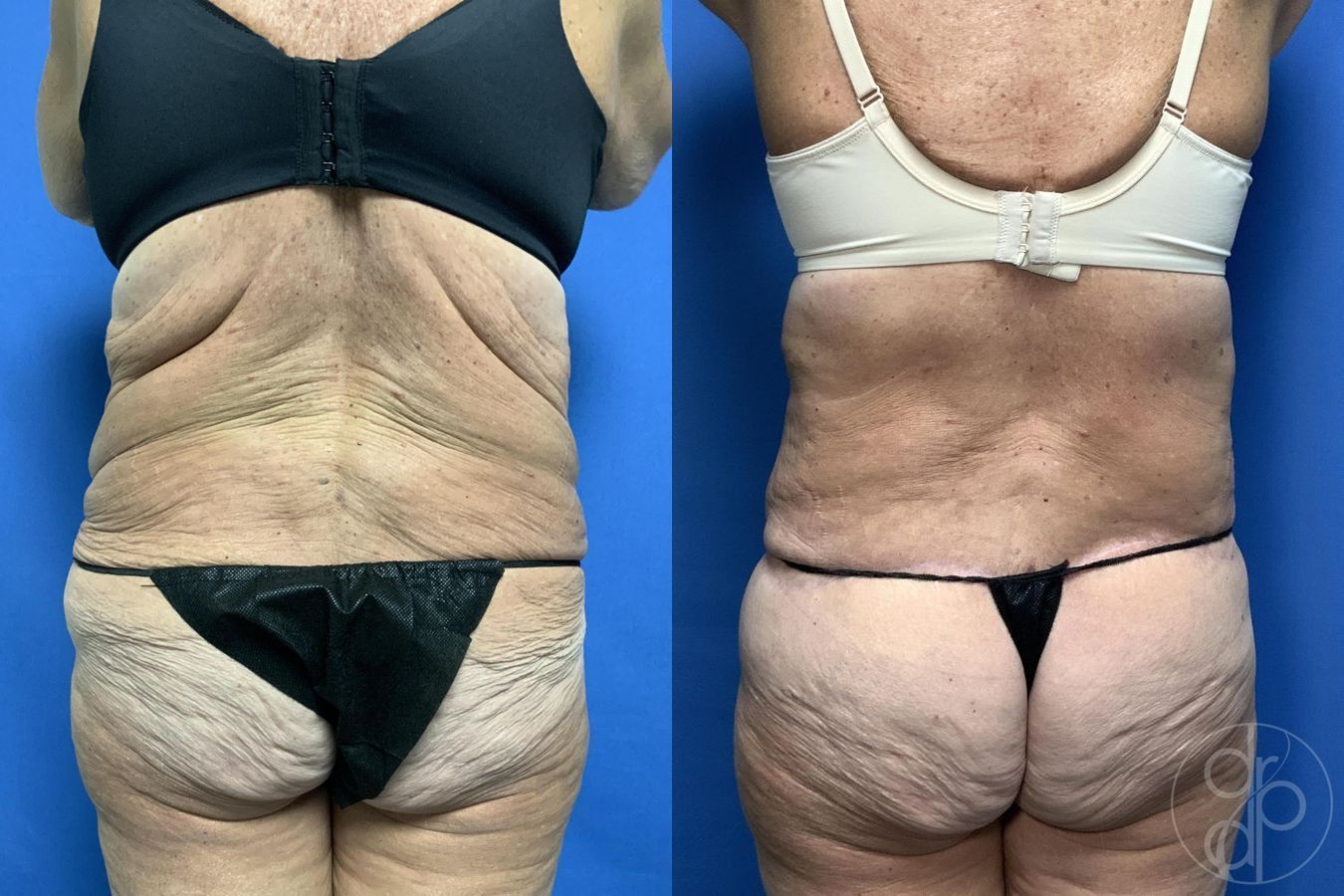 Before and after Abdominoplasty case 29620 - Angle 5