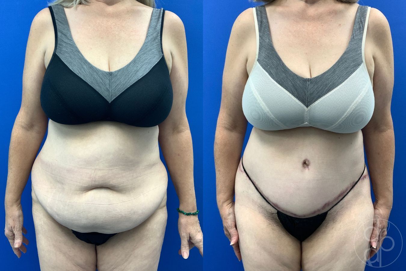 Before and after Abdominoplasty case 43487