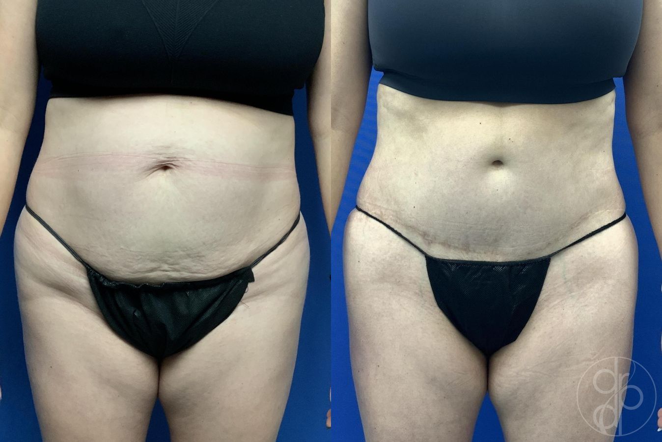 Before and after Abdominoplasty case 30018