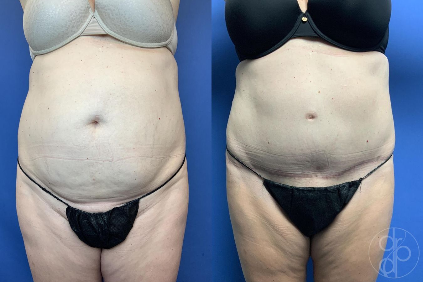 Before and after Abdominoplasty case 29586