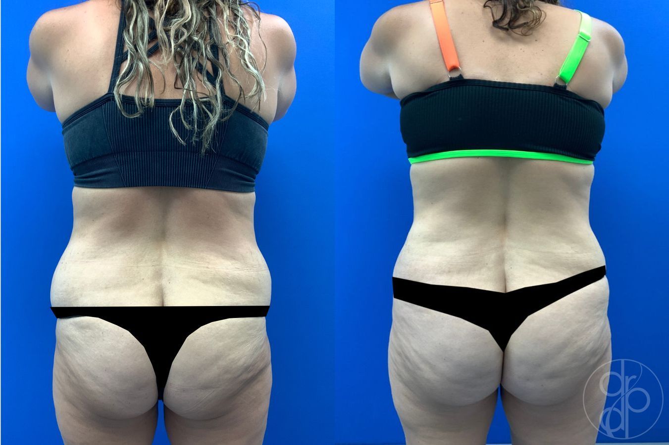 Before and after Liposuction case 43452 - Angle 6