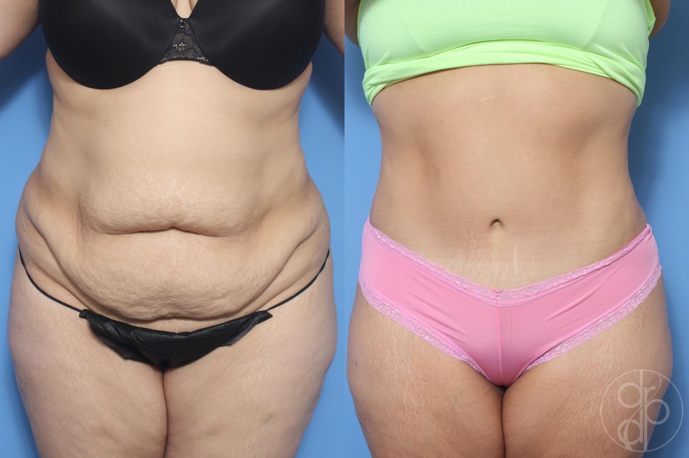 Before and after Abdominoplasty case 29532