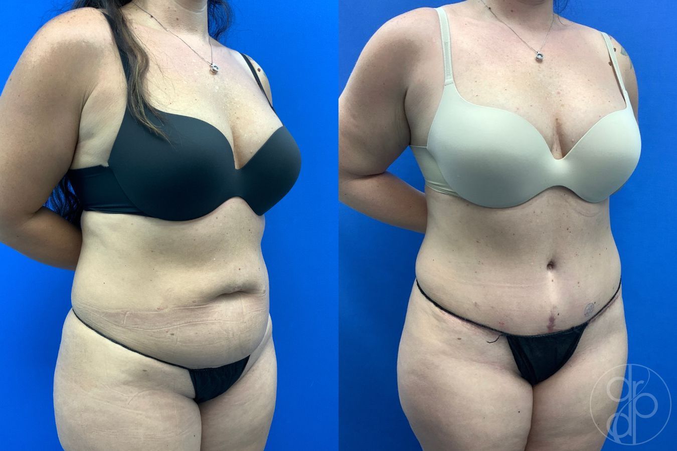 Before and after Abdominoplasty case 43461 - Angle 4