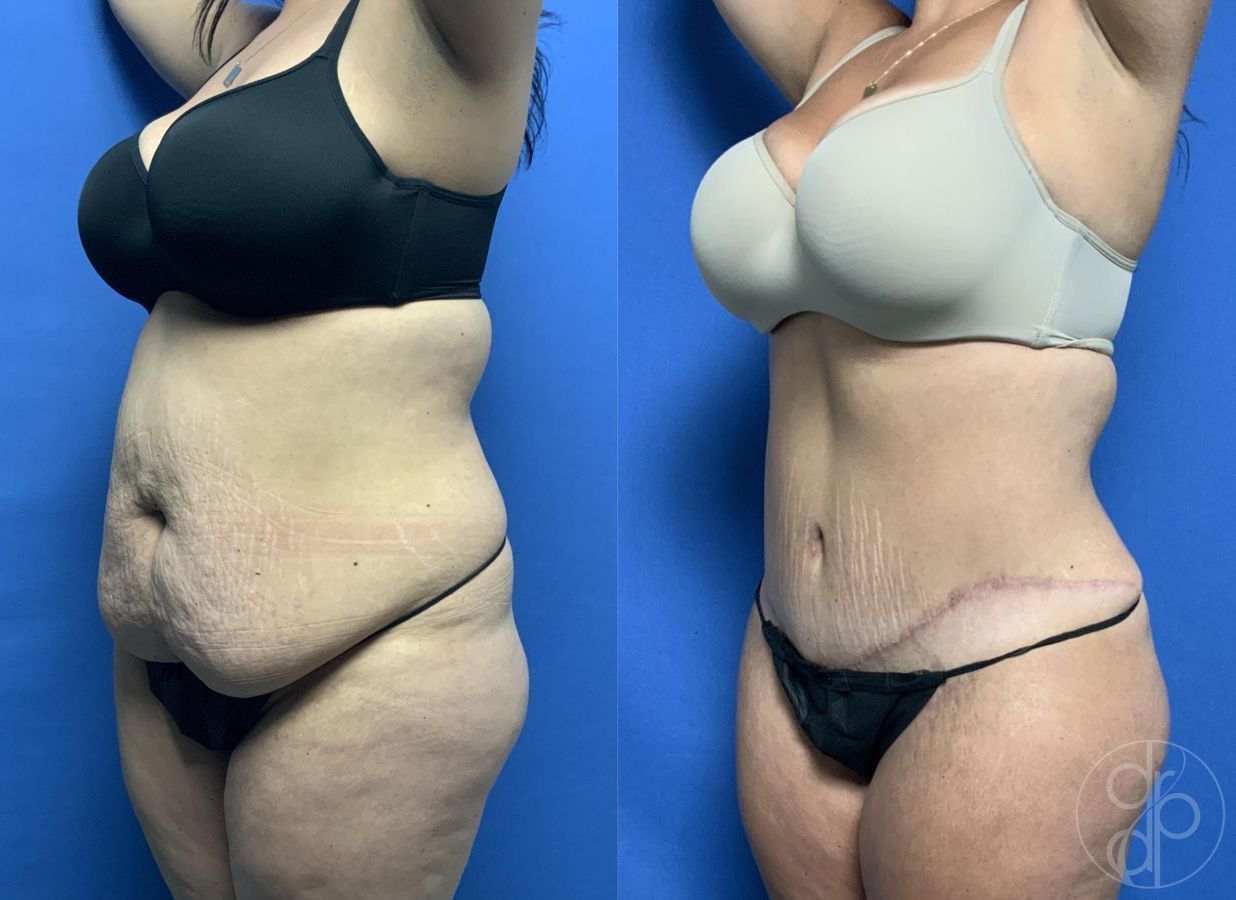 Before and after Abdominoplasty case 29578 - Angle 3