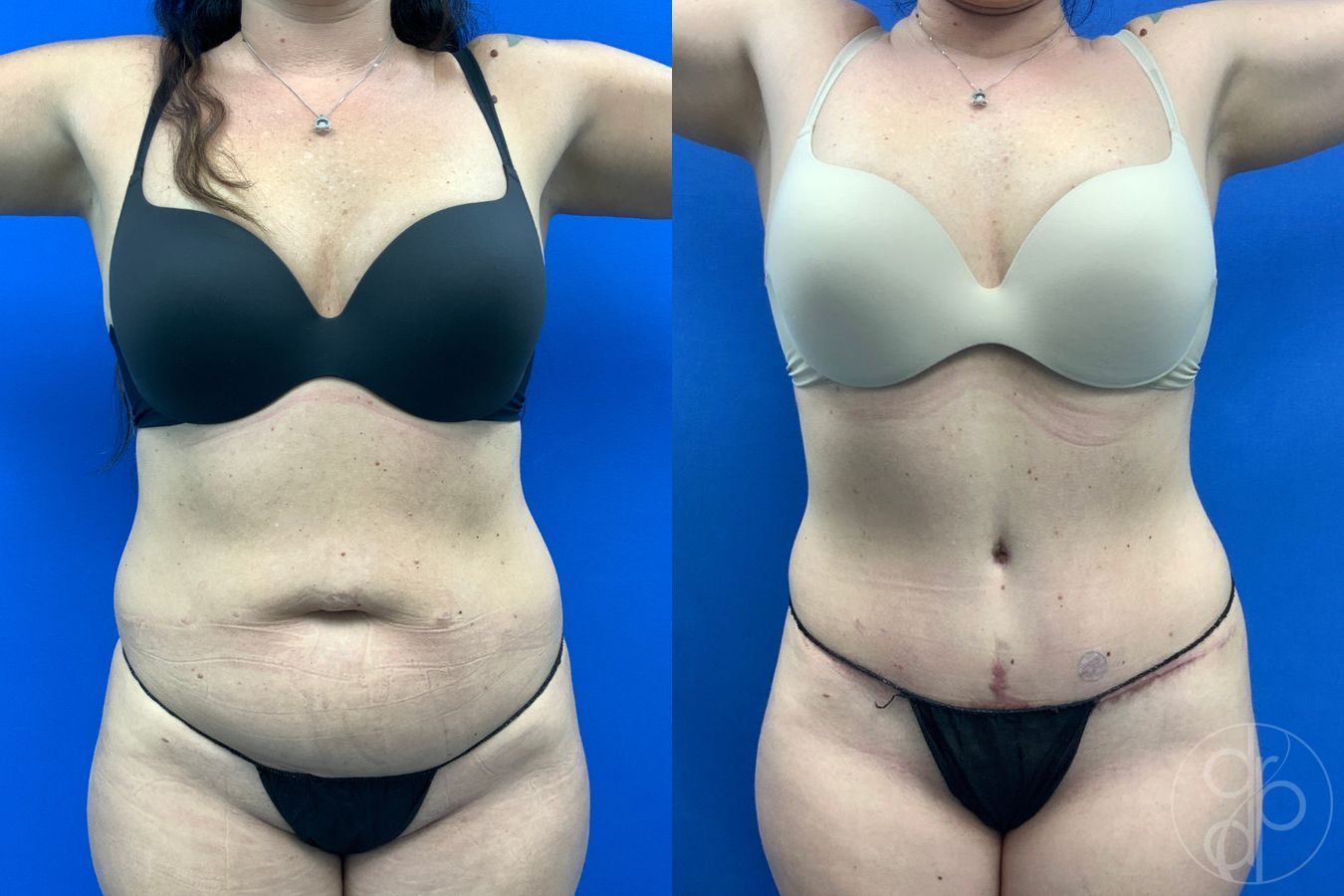 Before and after Abdominoplasty case 43461 - Angle 2