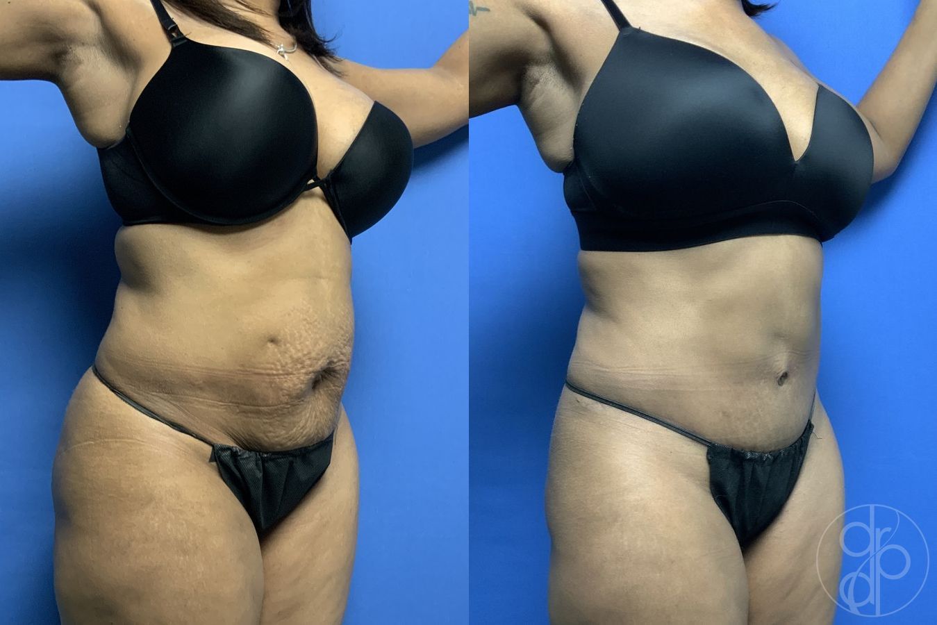 Abdominoplasty - Thumbnail 2