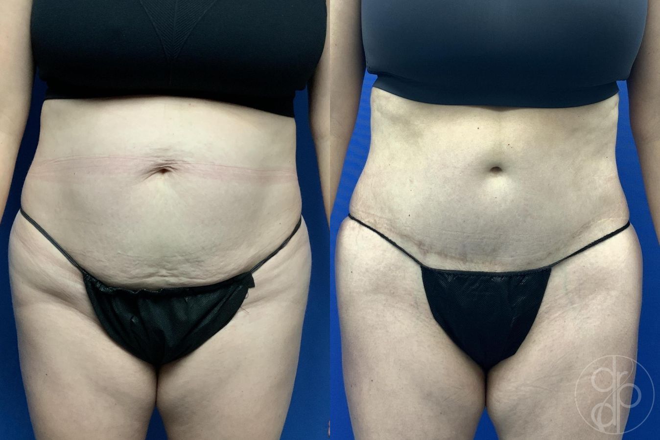 Before and after Abdominoplasty case 30018