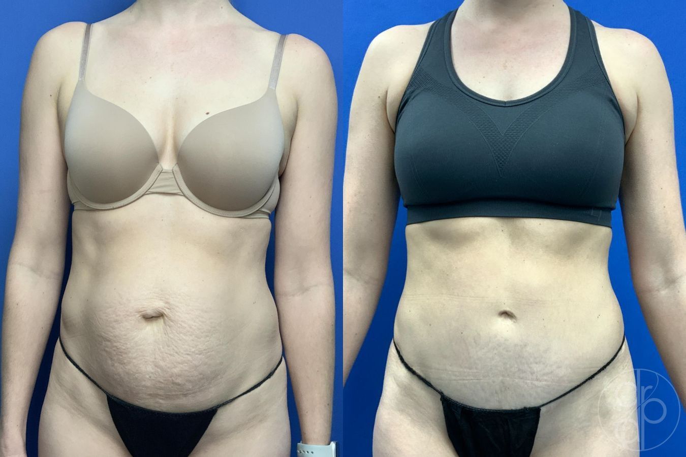 Before and after Abdominoplasty case 30012