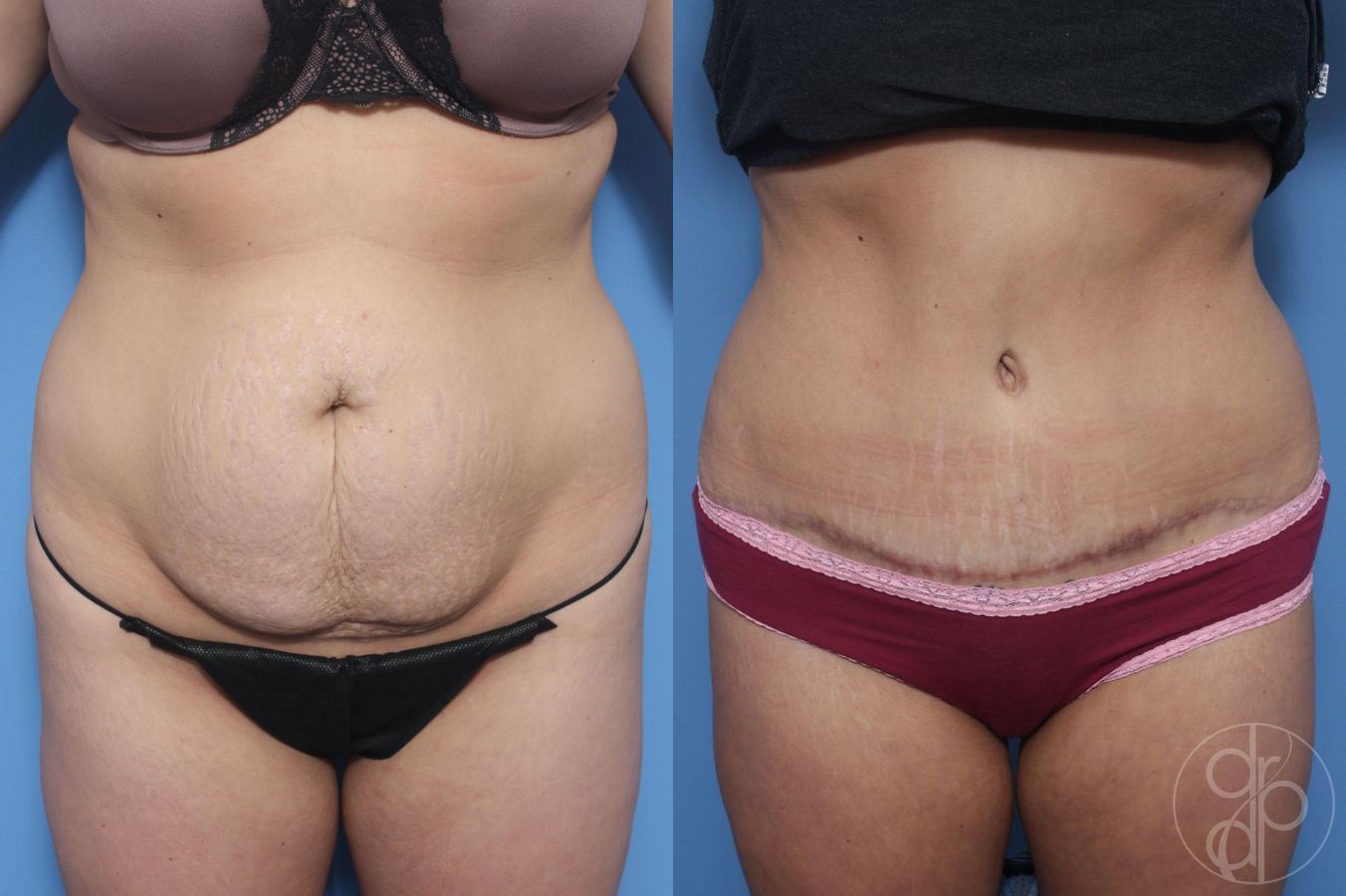 Before and after Abdominoplasty case 29526