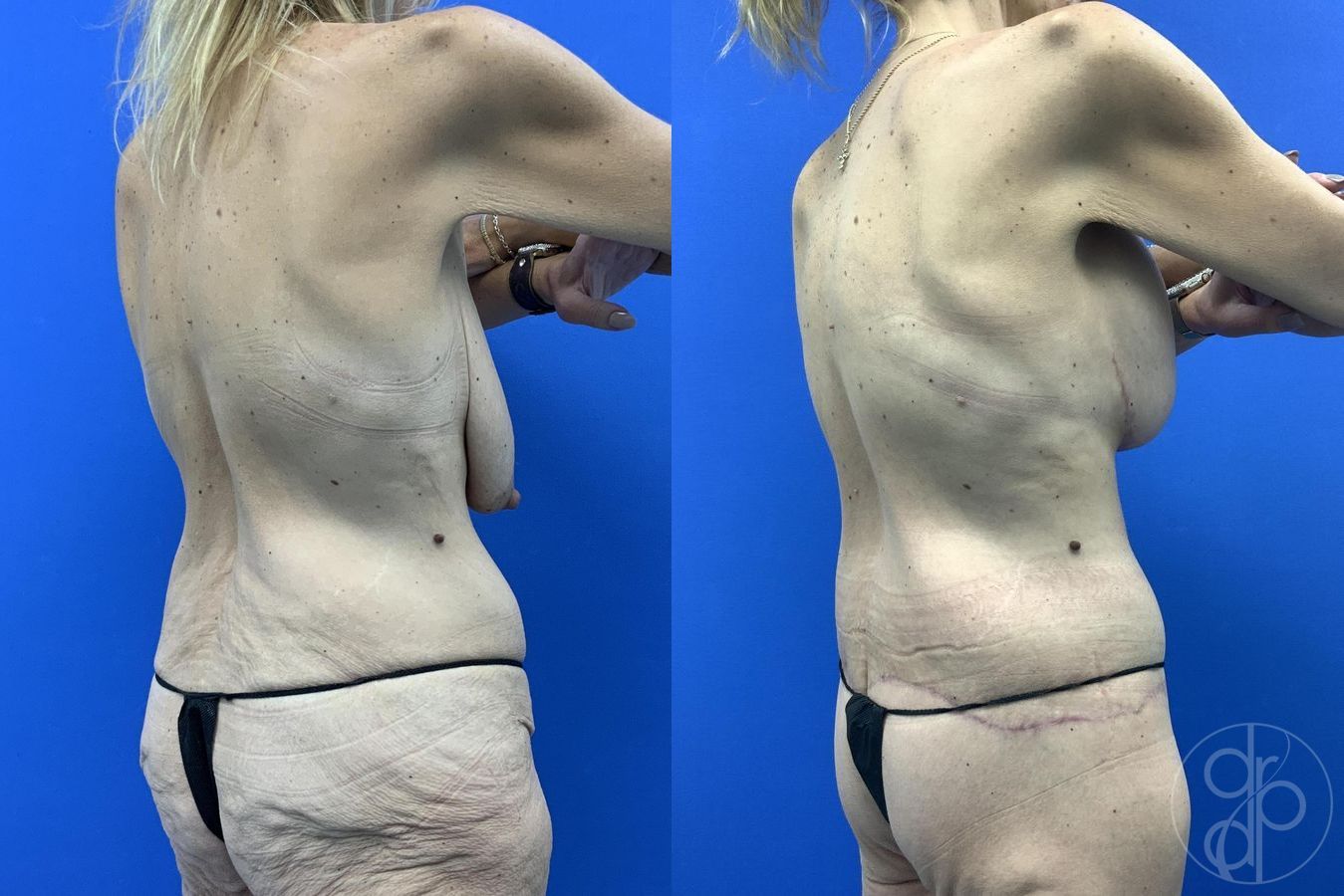 Before and after Abdominoplasty case 29983 - Angle 8