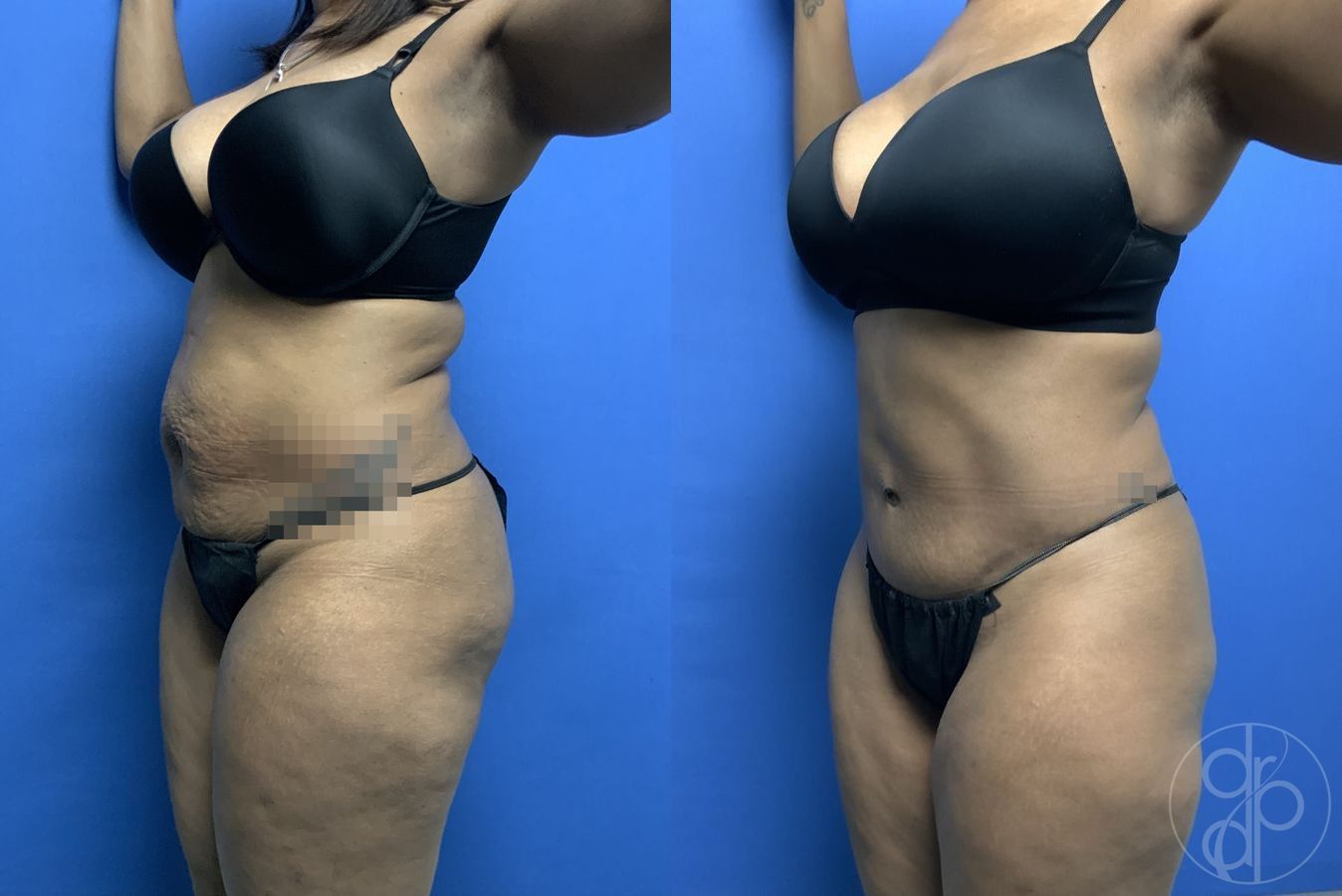 Abdominoplasty - Thumbnail 3