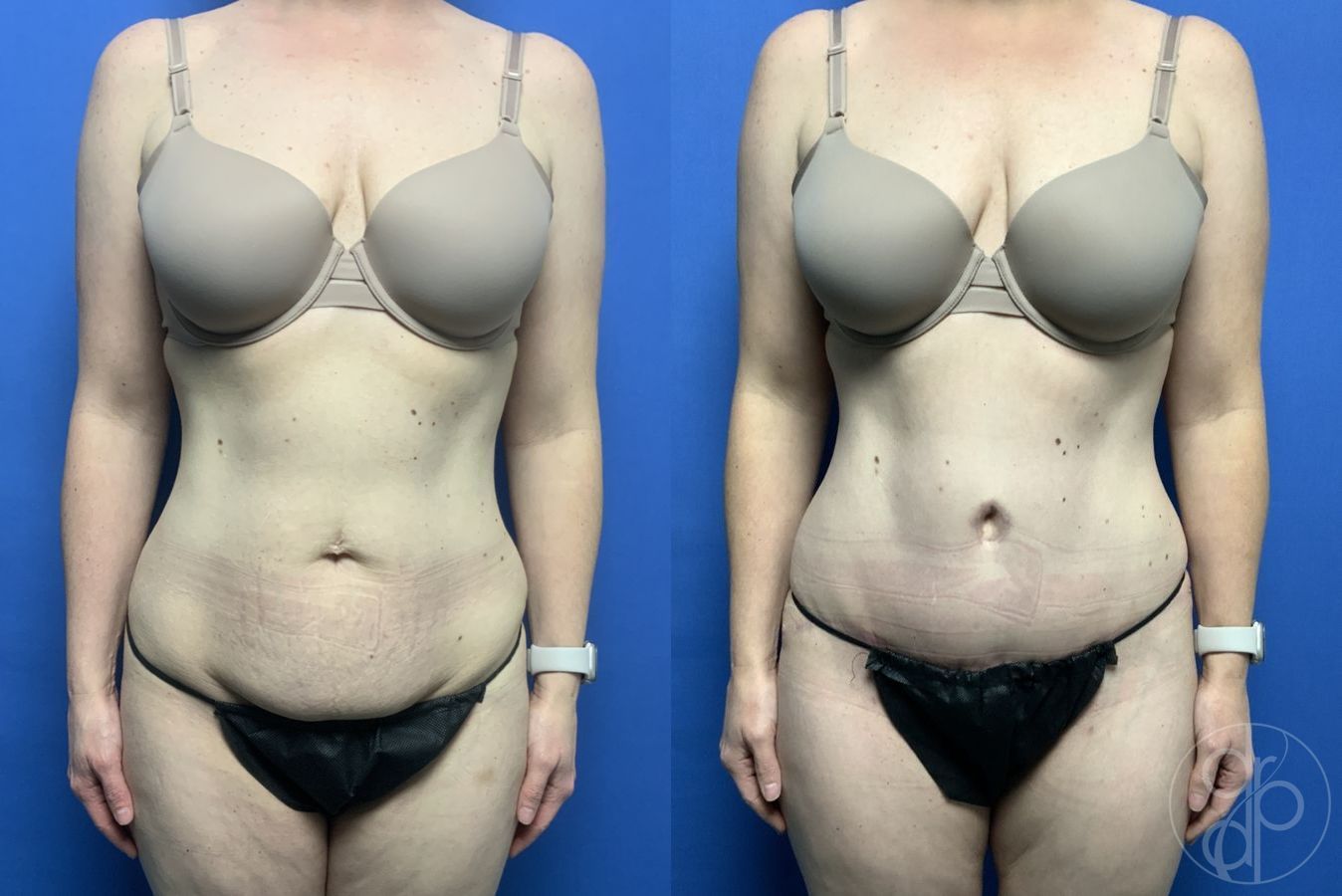 Before and after Abdominoplasty case 29568