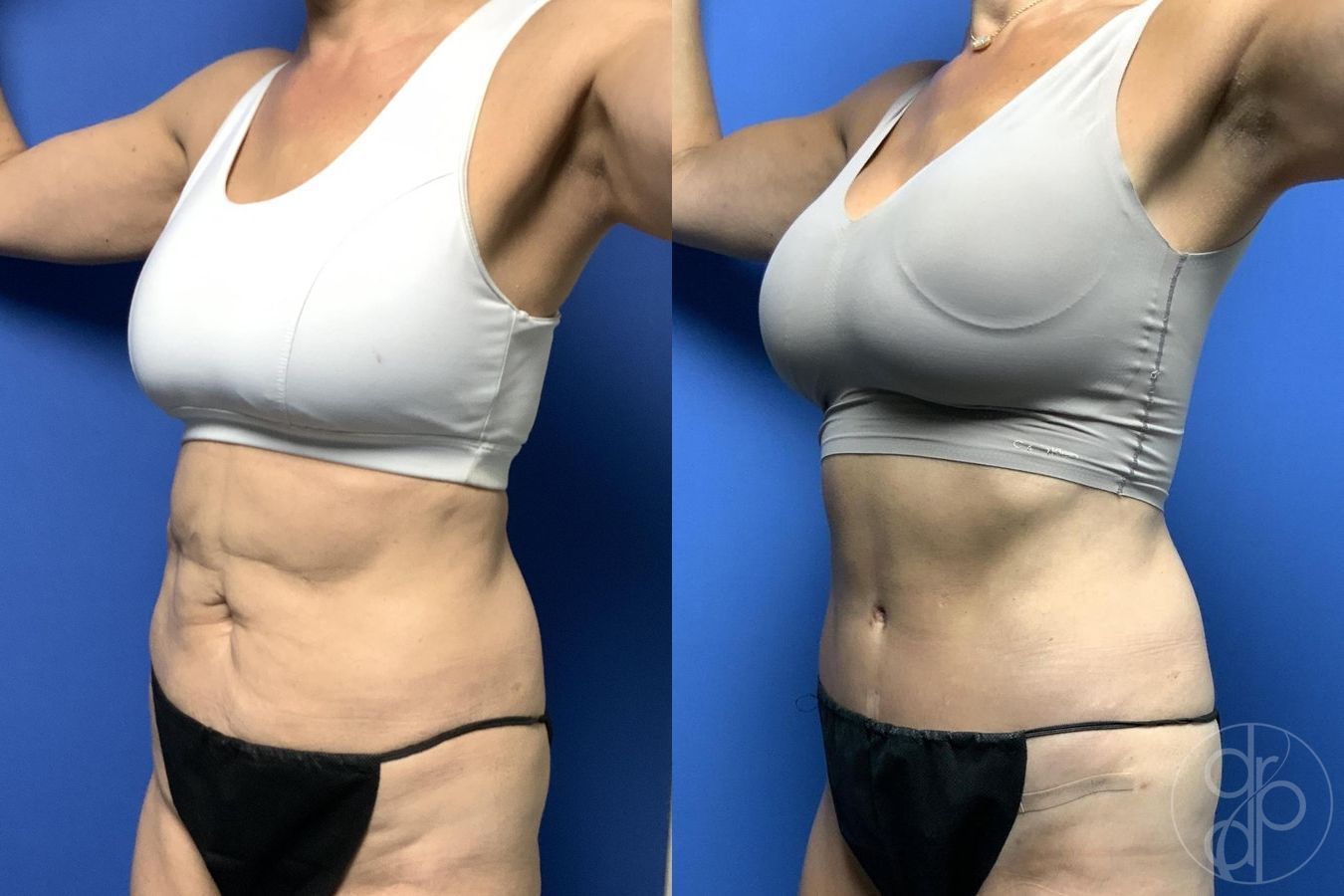 Before and after Abdominoplasty case 29647 - Angle 4