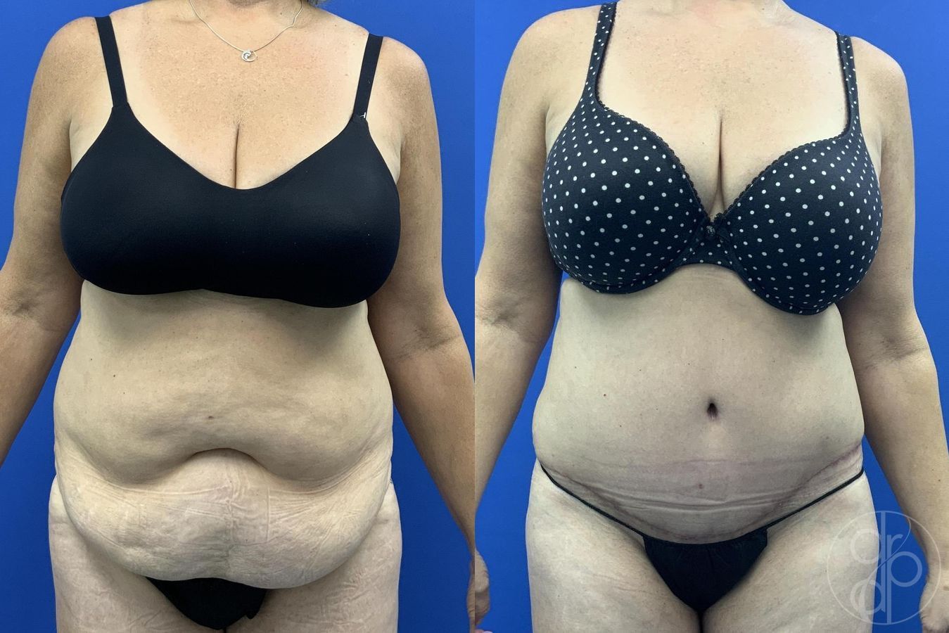 Before and after Abdominoplasty case 29619