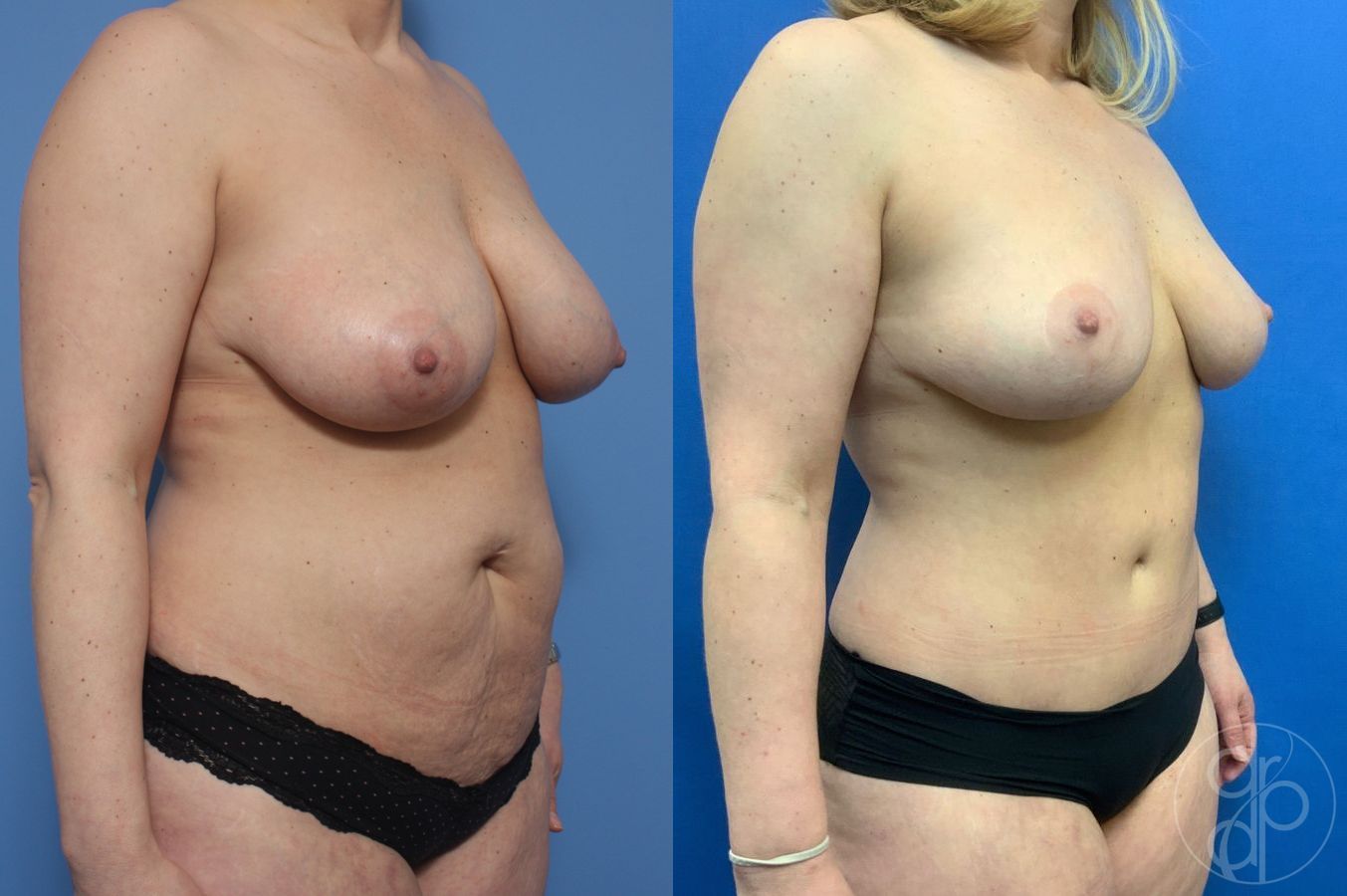 Before and after Breast Reduction case 29668 - Angle 2
