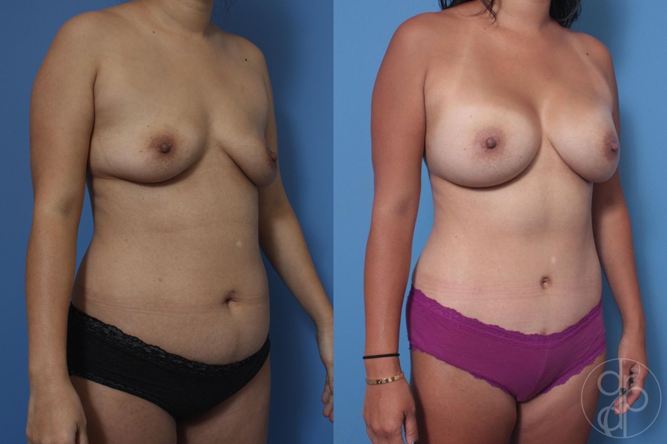 Before and after Abdominoplasty case 29697 - Angle 3