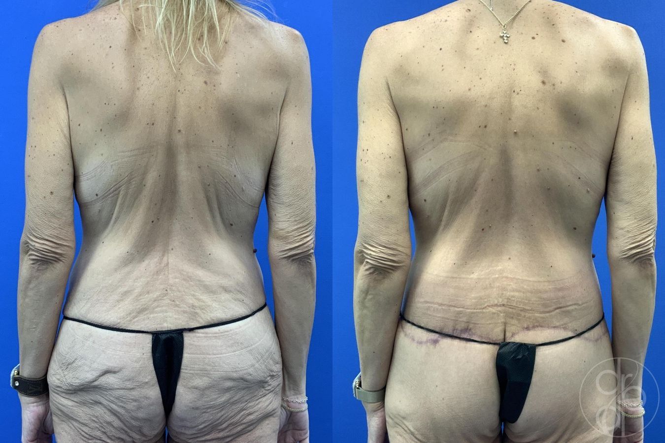 Before and after Abdominoplasty case 29983 - Angle 10