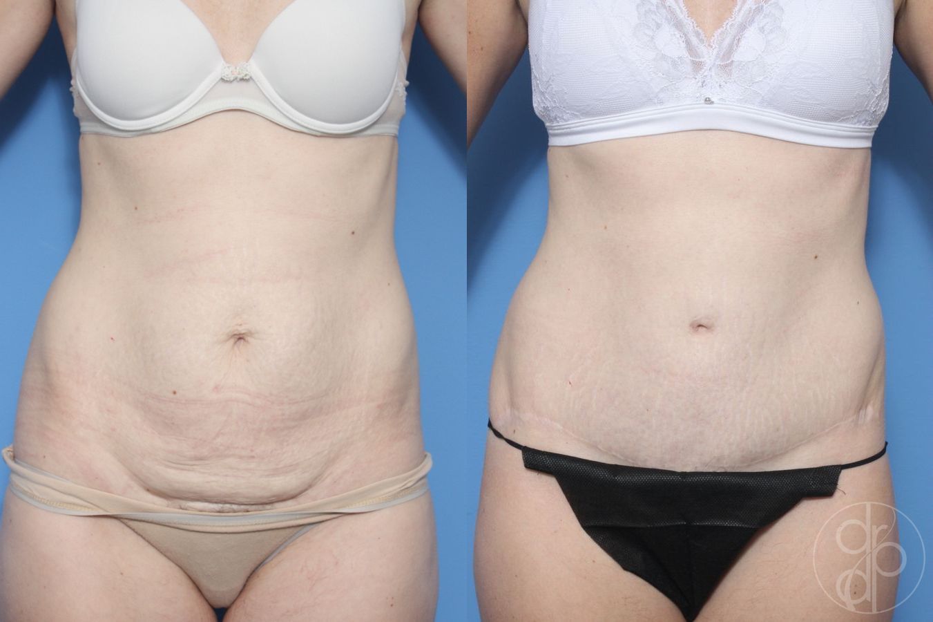 Before and after Abdominoplasty case 29570 - Angle 2