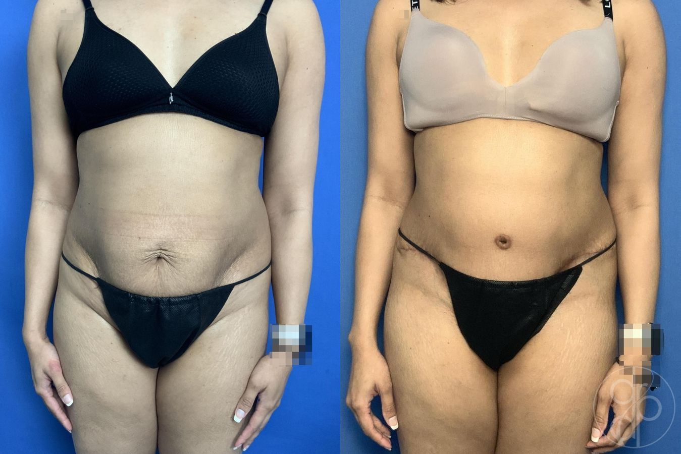 Before and after Abdominoplasty case 29583