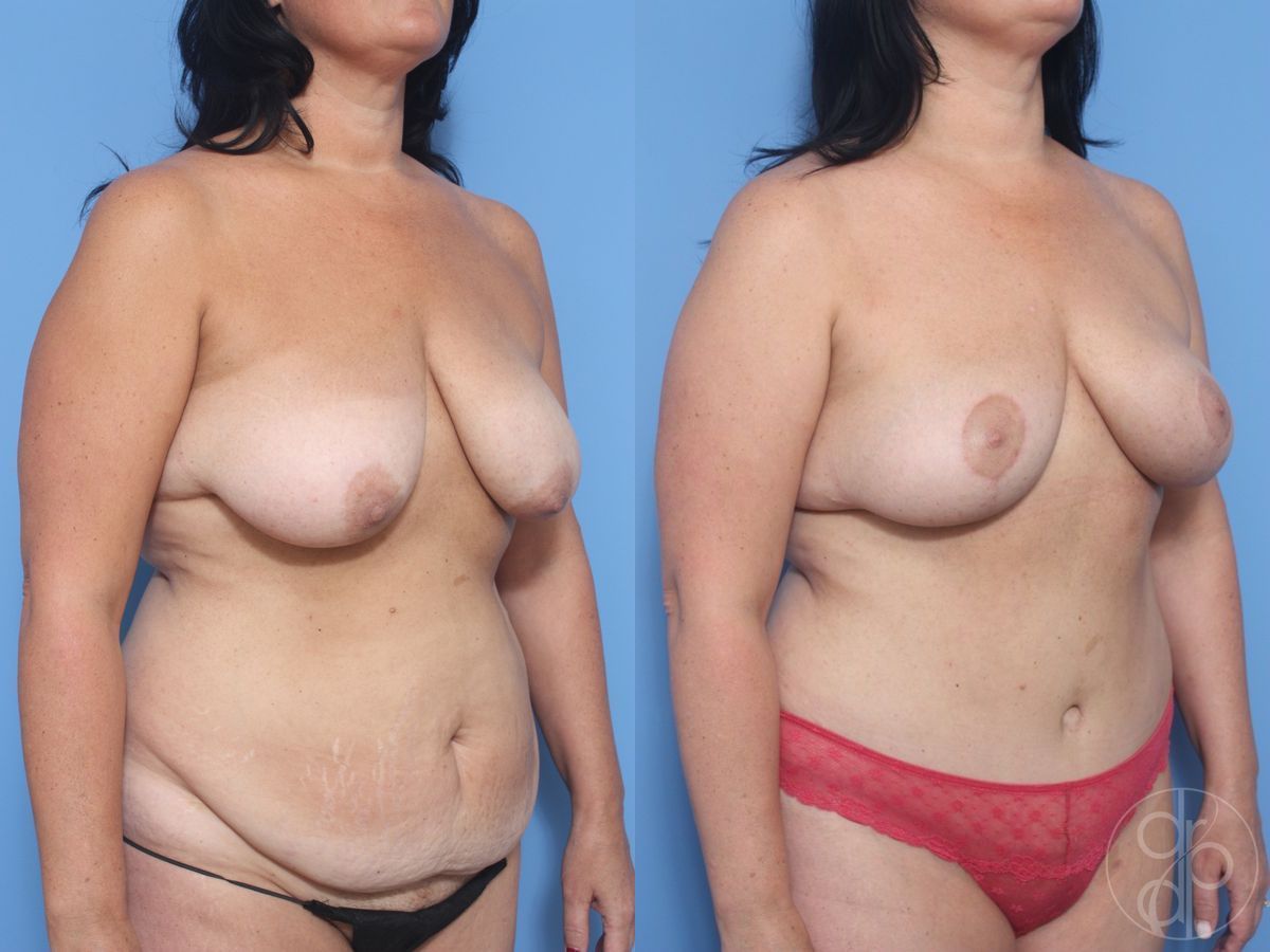 Before and after Abdominoplasty case 29695 - Angle 2