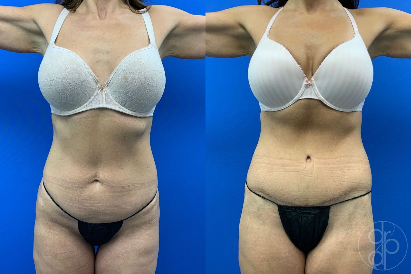 Before and after Abdominoplasty case 43480 - Angle 2
