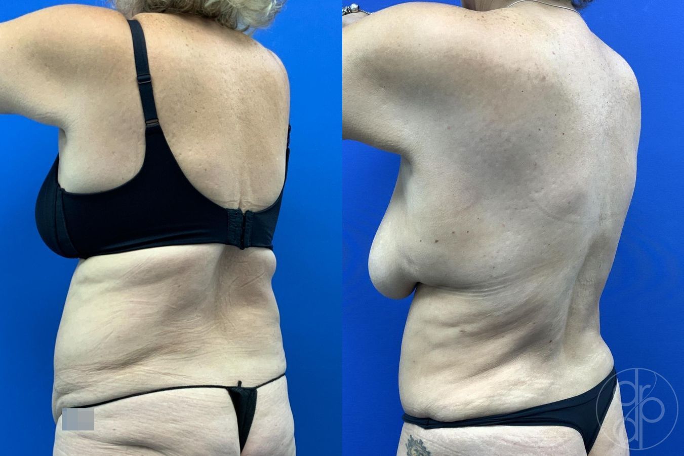 Abdominoplasty - Thumbnail 7