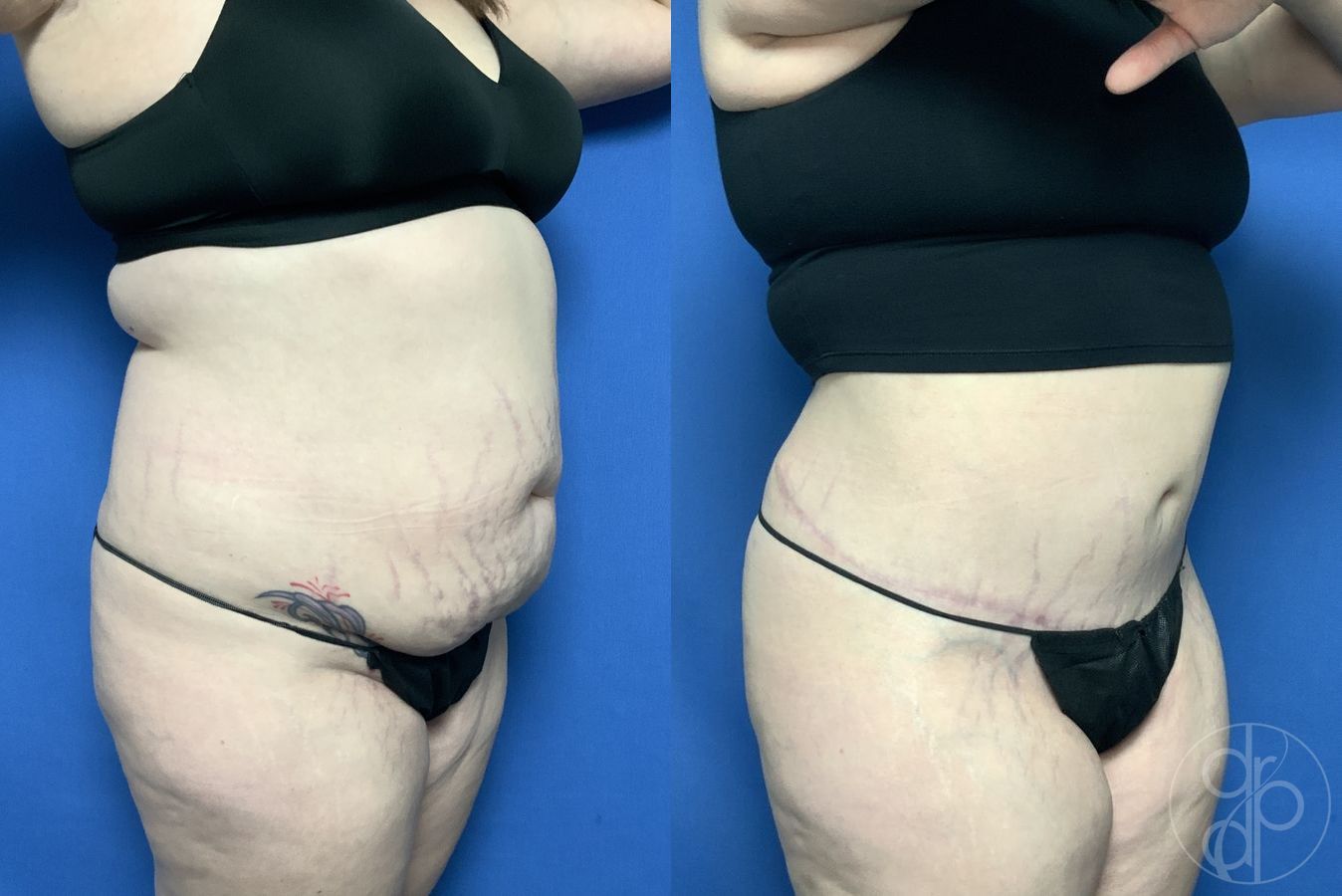 Before and after Abdominoplasty case 29576 - Angle 2