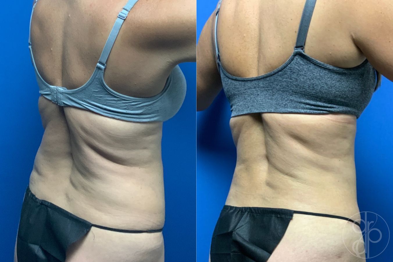 Before and after Liposuction case 46422 - Angle 5