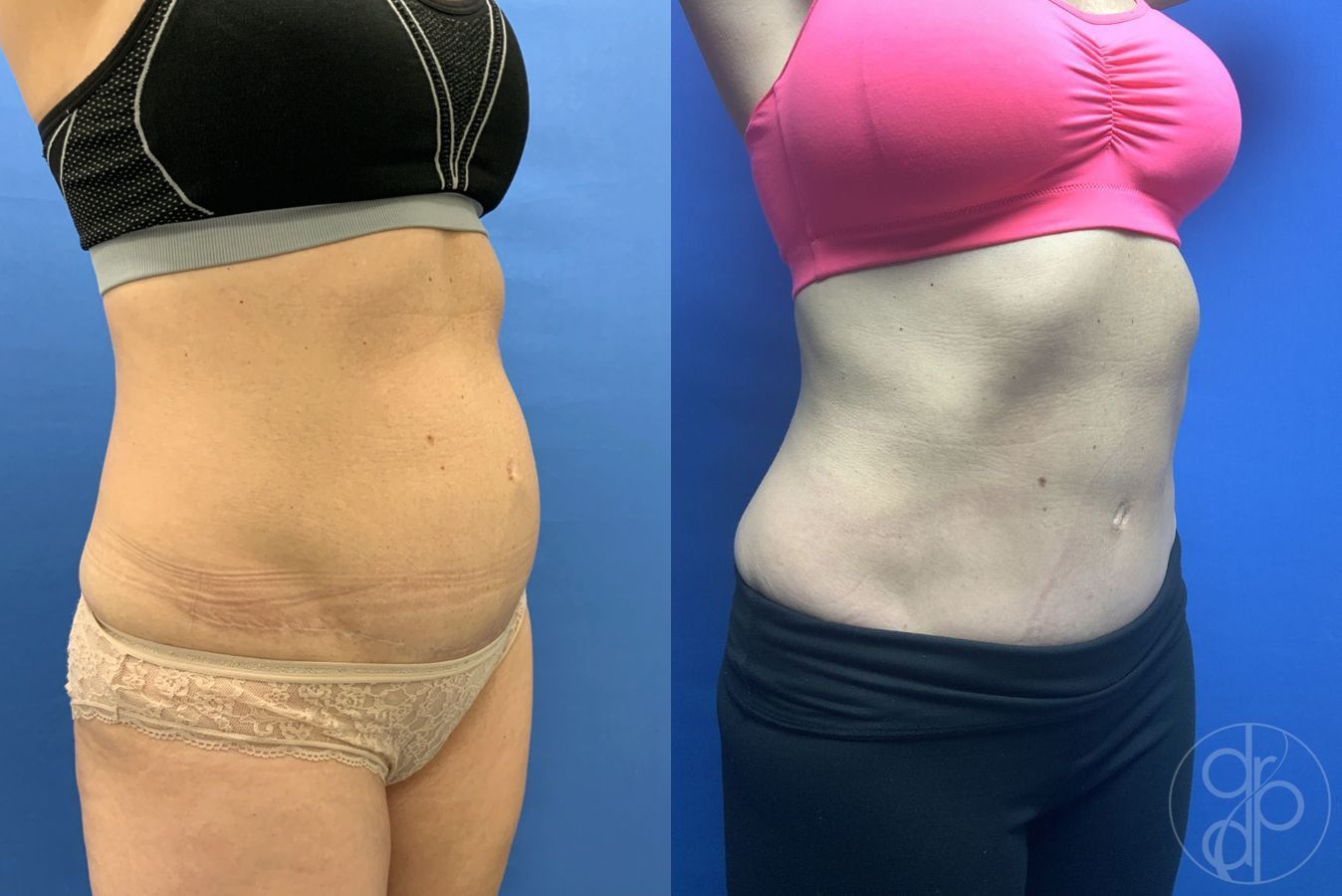 Before and after Abdominoplasty case 29572 - Angle 2