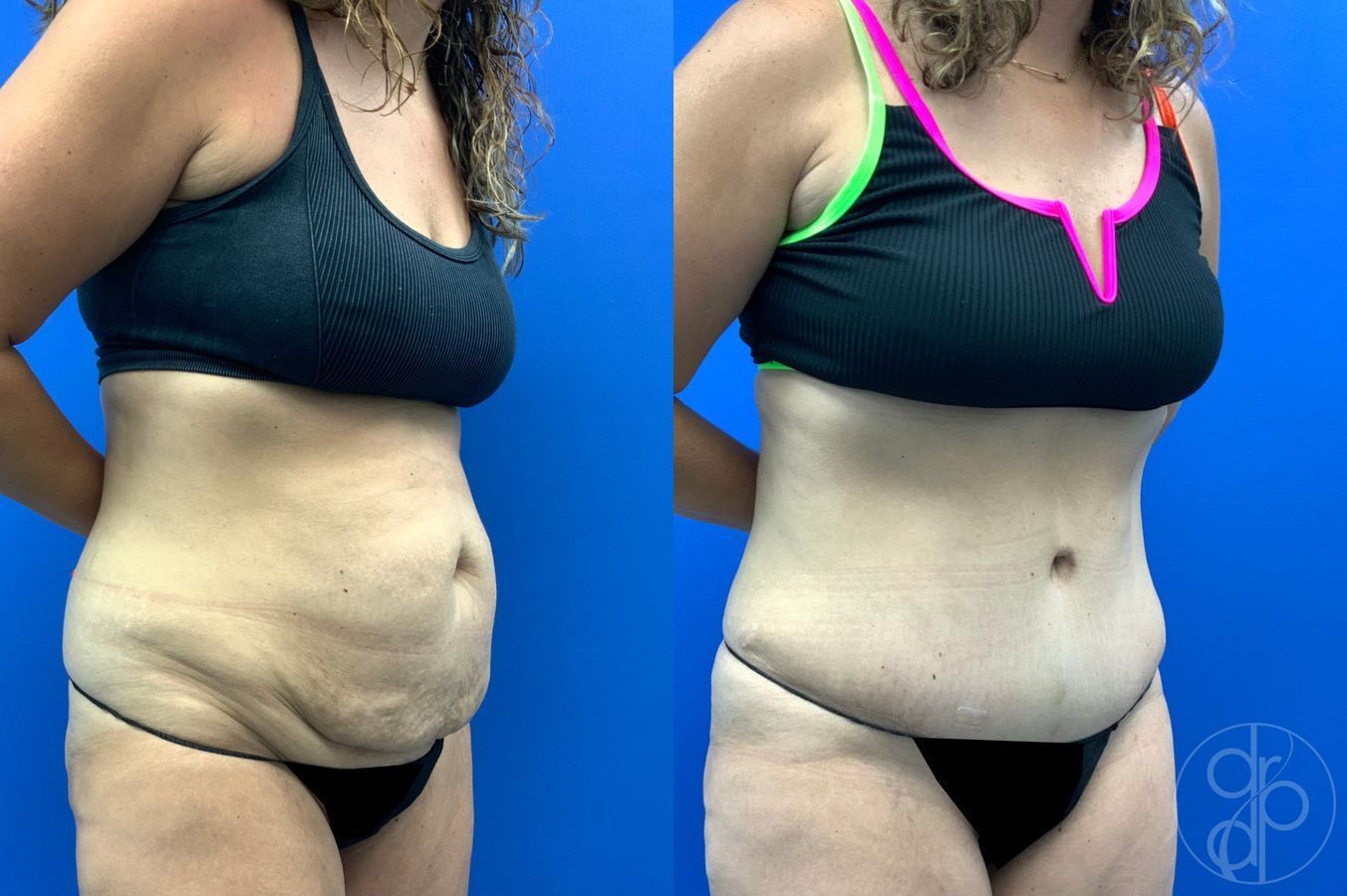 Before and after Liposuction case 43452 - Angle 3